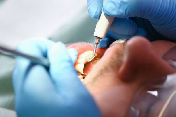 Best Emergency Wisdom Tooth Extraction in Allendale, CA